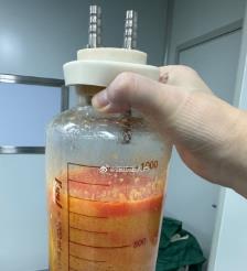 丹东水动力吸脂手术要做多久？